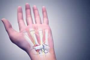 Carpal Tunnel Syndrome