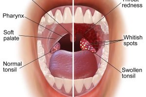 How to Get Rid of Tonsil Stones
