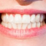 The Popularity of Veneers for the Ideal Smile