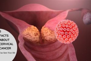Cervical Cancer