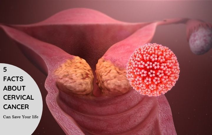 Cervical Cancer Cervical Cancer