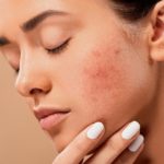 Hormonal Acne Natural Treatments